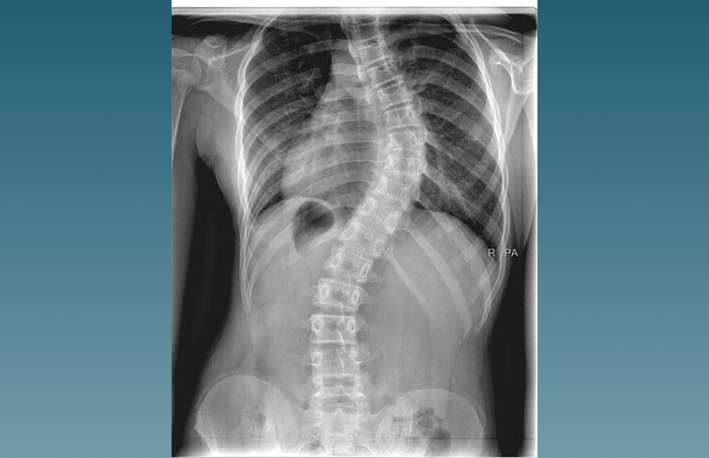 Destrucción vertebral