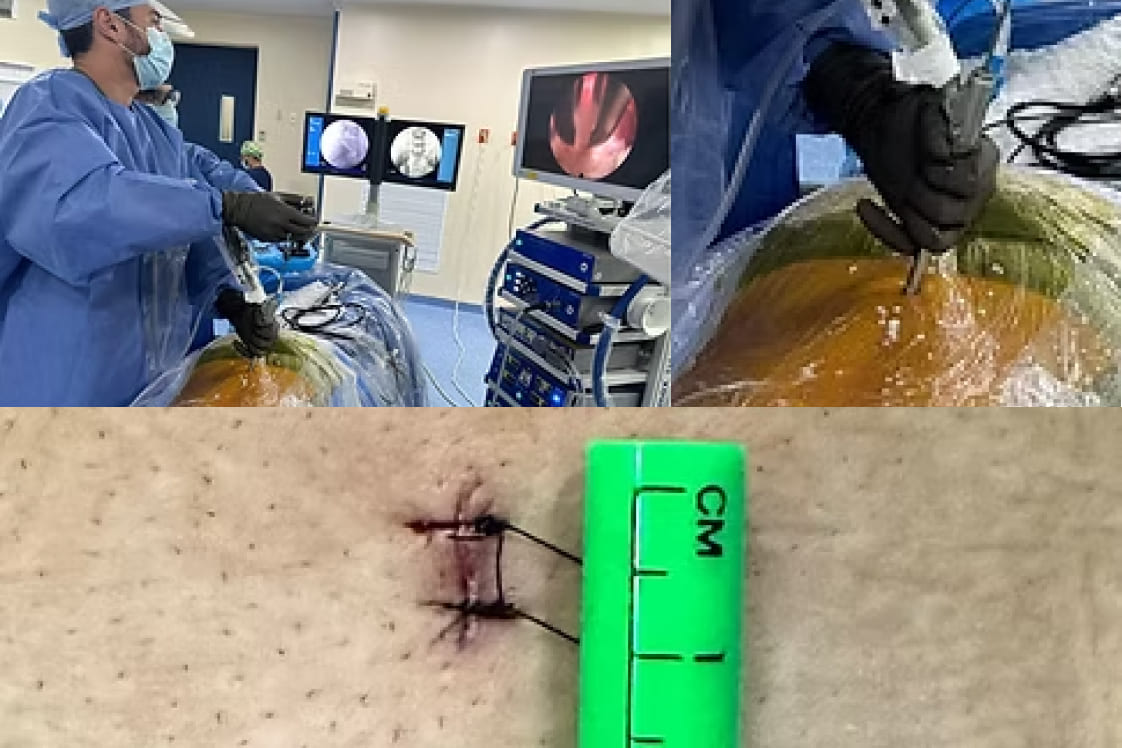 Endoscopia de columna en Veracruz: Tu solución para hernias de disco y alivio de lumbalgia