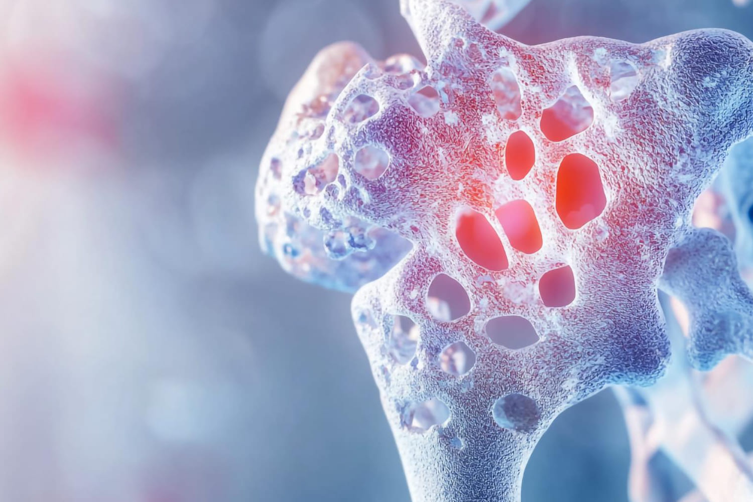 Fracturas por osteoporosis