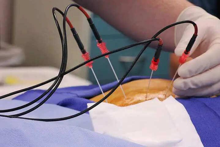 Técnicas mínimamente invasivas